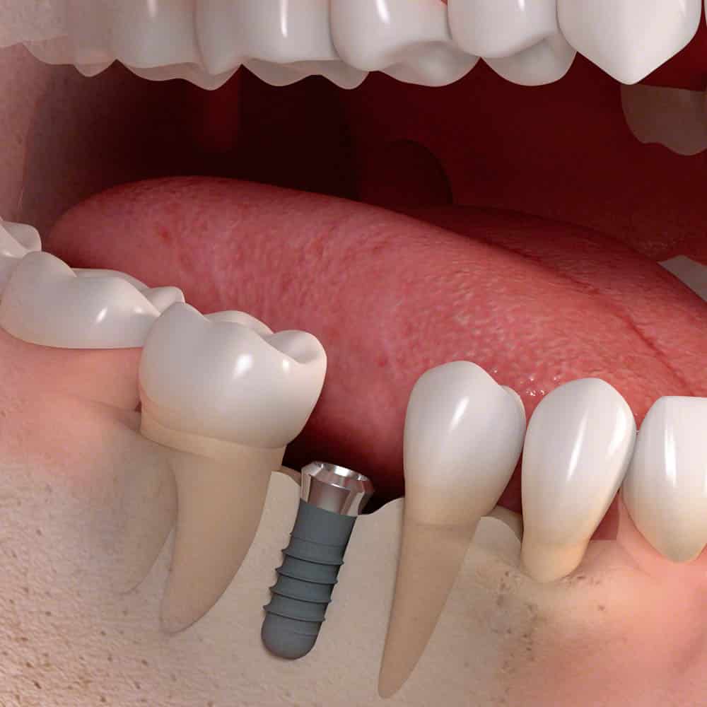 Dental Implants Dental Implants