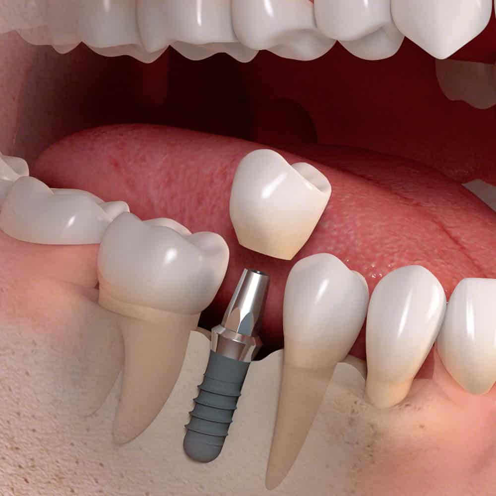 Dental Implants Dental Implants
